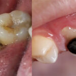 Caries infantil cae 15 puntos, pero 42% de los niños aún tiene lesiones sin tratar Salud bucal infantil.