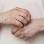 Sífilis y gonorrea registran sus tasas más altas de la década en Chile: ¿qué explica el aumento? Sífilis.